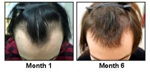 If that little space is sending chills down your spine, sit back and relax because in this menwit article, you can go through different widow's peak hairstyles that enable you to hide it as well as attenuate it. Widow S Peak Warning Of Hair Loss In Men