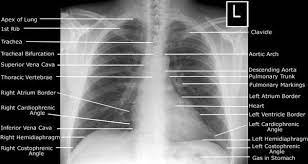 Note the larger appearing heart on the ap view. Normal Chest Xray Http Epomedicine Com Medical Students Systematic Approach To Frontal Chest X Ray Radiography Student Xray Technician Radiology Student