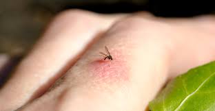 Image result for Papular urticaria