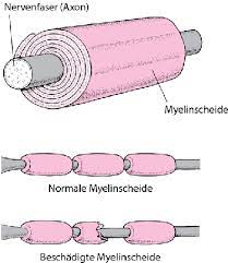 Symptoms of gbs include muscle weakness, numbness, and tingling sensations, which can increase in intensity until the muscles cannot be used at all (). Guillain Barre Syndrom Gbs Storungen Der Hirn Ruckenmarks Und Nervenfunktion Msd Manual Ausgabe Fur Patienten