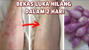 Maybe you would like to learn more about one of these? Cara Menghilangkan Bekas Luka Di Kaki Tangan Cepat Dan Alami Wulanhusna Youtube