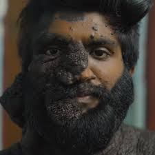 80% Of My Skin Is Covered In Moles