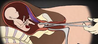 Resultado de imagen para aborto