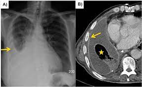 34 the fluid may accumulate due to overproduction from diseased pleura, obstruction of lymphatic channels, or atelectasis of adjacent lung. Epos Trade