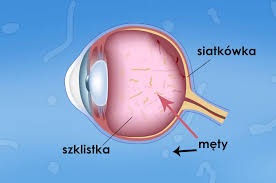 Diagnoza polega na badaniu dna oka. Mety W Oku Co To Sa Mety W Oku Leczenie Metow Witreoliza