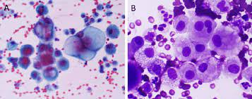 We did not find results for: Mesothelioma In A Pleural Fluid Specimen Atypical Mesothelial Cells Download Scientific Diagram