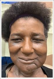 18 months follow-up after reconstruction of the left retromolar trigone... 