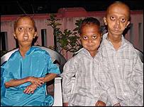 Image result for progeria case in bihar