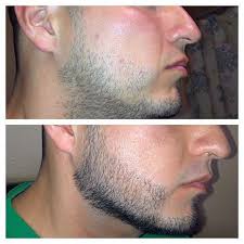 Minoxidil is used for alopecia, hypertension etc. Minoxidil Rogaine For Beard Growth For Fuller And Thicker Facial Hair Beardoholic