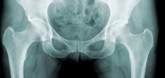 Image result for Intrathecal Pump