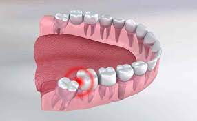 Wisdom teeth are a third set of molars in the back of your mouth. Effective Natural Cures To Soothe Wisdom Toothache Odyssey Dental Of Summerfield