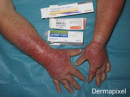 Dermapixel Dermatitis De Contacto Irritativa No Es Alergia Pero Pica Lo Mismo