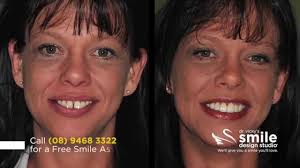 If you want to fix your crooked teeth, first go to the orthodontist to discuss which treatment options will be best for you. Fixing Crooked Teeth With Porcelain Veneers Smile Design Studio Youtube