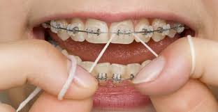 When the brackets are removed from your teeth, we carefully polish the enamel and use more special tools to completely remove the cement. Is It Possible To Remove Stains From Braces Brodie Bowman Dmd