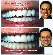 The remedies suggest that you don't have to use braces. How To Straighten Teeth Without Braces Teethwalls