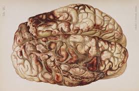 Send a message to the brain two men climbing down opposite poles the one with hair upon his face sprouting like the weeds on his soul the other is a law unto himself his brain is like. Penetrating Head Injury Wikipedia