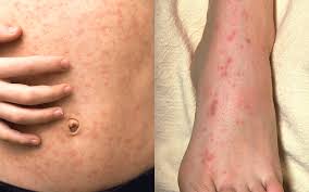 Image result for allergy rash on the legs