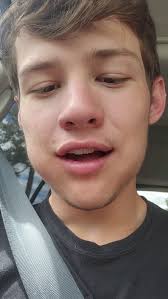 wisdom tooth reveal… sorry guys this is so gross #wisdomtoothextraction  #wisdomteeth