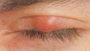 Ein hagelkorn (chalazion) ist ein gerötetes, warmes und schmerzhaftes knötchen unter oder auf dem augenlid, das sich innerhalb von ein bis zwei tagen entwickelt. Unbenanntes Dokument
