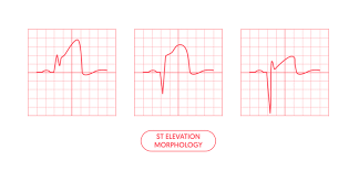 Image result for ST Elevation