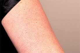 Ever Wonder What Those Annoying Little Red Bumps Are On Your Upper Arms They Are Called Keratosis Pilaris Or Kp And Red Bumpy Skin Skin Bumps Dry Skin Bumps