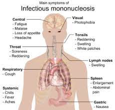 Mononucleosis, or mono, is a viral infection that causes fever, sore throat, and swollen lymph glands, most often in the neck. Infectious Mononucleosis Wikipedia