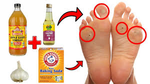 A baking soda bath soak is good for more than just relaxation. 14 Proven Home Remedies For Corns Callus Removal That Work Youtube