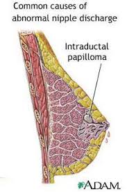 Pin On Papiloma