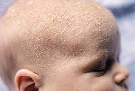 Almost all people with these skin cancers can be cured by specialist. Baby Skin Care Tips To Keep Newborn S Skin Healthy