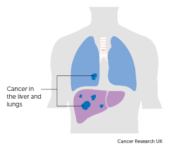 Liver cancer can be primary (starts in liver) or secondary. Stage 4 Liver Cancer Cancer Research Uk