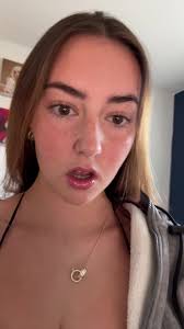 the freckles are already gone 💔