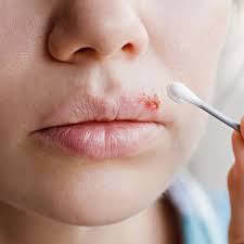 Herpes simplex i löst das lippenherpes aus, herpes simplex ii ist für genitalherpes verantwortlich. Herpesblaschen Das Sollten Sie Wissen Und Jetzt Tun Gala De