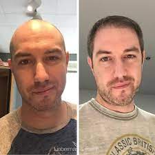 Hair Restoration Blog San Francisco Bay Area Lieberman Parikh Read The Latest News Information And Updates From The Lieberman Parikh Center For Hair Restoration Blog For The