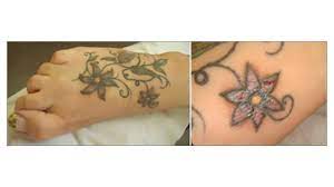 Tattoo Allergy Rash And Other Reactions To Ink Treatment More