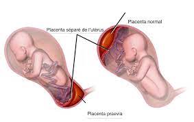 Le placenta est un élément essentiel de la grossesse : Placenta Praevia Neufmois Fr
