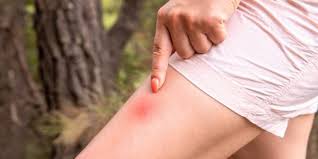 Image result for Insect Bite