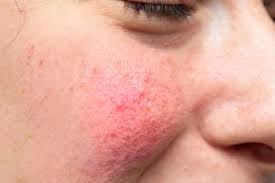 Rosacea Conheca As Causas Tratamento E Produtos Indicados Beleza Com Saude