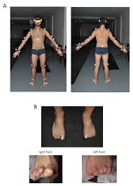 Image result for toe amputation