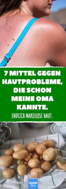 Auch wenn alle wissen wie dieses leiden entsteht und wie man sich dagegen schützen kann, passiert es doch alle jahre wieder. 7 Mittel Gegen Hautprobleme Die Schon Meine Oma Kannte Hautpflege Haut Kosmetik Sonnenbrand Akne Leberfleck Al In 2020 Hautprobleme Leberfleck Apfelessig Haut