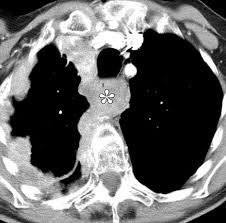 Epithelioid cells are common in both malignant pleural and peritoneal mesothelioma. Malignant Pleural Mesothelioma Evaluation With Ct Mr Imaging And Pet Radiographics