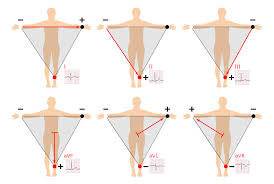 12 Lead Ecg Placement Guide With Illustrations