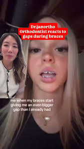 Canted teeth after getting braces? It's often due to impacted canines  shifting things around. Don't wait! Mention this to your Orthodontist as  soon as you see this, so it doesn't worsen! #orthodontics #