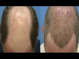 البرفيسور الغامدي يحذر من زراعة الشعر في الخارج تكلفة زراعة الشعر في السعودية Hair Removal Spray Cool Hairstyles Cheap Hair Products