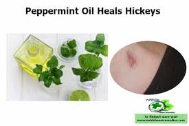 Jan 10, 2021 · 20 best home remedies to get rid of a hickey mark (love bite) fast. 11 Best Ways To Get Rid Of A Hickey Fast Coin Ice Chapstick