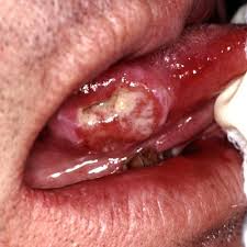 Image result for cancer tongue symptoms)