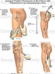 surgical fixation procedure of the