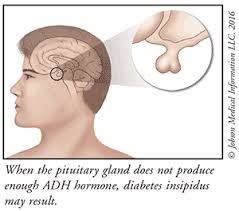 Diabetes Insipidus - Pituitary Gland - Diabetes Insipidus | Treatment best Option | Best Homeopathic Doctor in Pakistan | Dr Qaisar Ahmed MD, DHMS