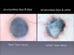 Image result for Blue Nevus