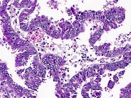 Mesothelioma is often harder to treat than other types of cancers because it s rare. All Of The Peritoneal Carcinoma Pathology Outlines