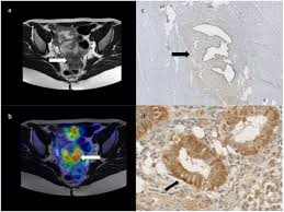 After taking your medical and symptom history, and after performing a pelvic exam, your provider may recommend imaging. Value Of The 68ga Dotatate Pet Ct In The Diagnosis Of Endometriosis A Pilot Study European Journal Of Obstetrics And Gynecology And Reproductive Biology